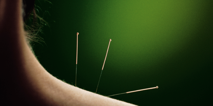 acupuntura